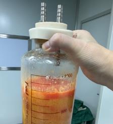 廊坊水动力吸脂手术要做多久？